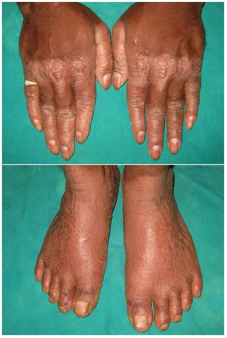 Penyakit Hiperkeratosis pada Kulit