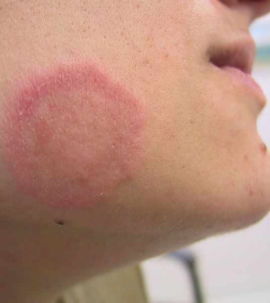Tinea Faciei